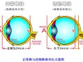 近视隐形眼镜怎么配度数，近视隐形眼镜一般的多少钱
