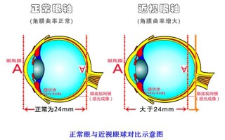 近视隐形眼镜怎么配度数，近视隐形眼镜一般的多少钱